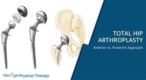 total hip arthroplasty treatment